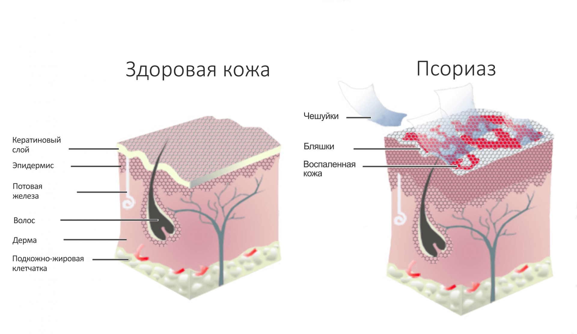 Что нужно знать о псориазе